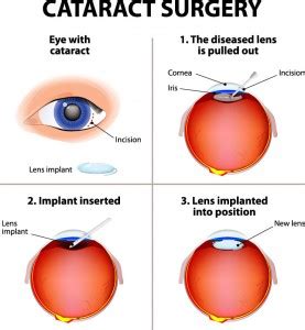 cataract surgery huddersfield|Ophthalmology Consultants in Huddersfield .